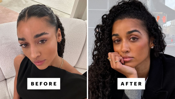 Influencer Eloise Dufka before and after receiving a hair transplant in Istanbul Turkey.